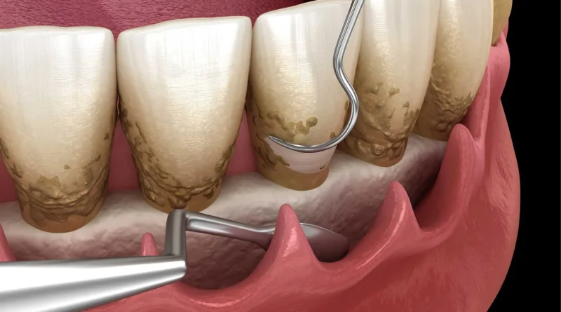 periodontal scaling and root planing in Houston, TX