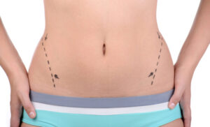 Pros and cons of liposuction surgery