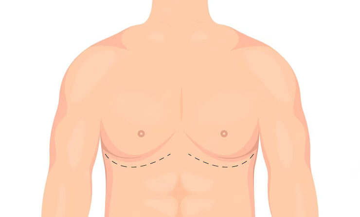 Is gynecomastia Surgery Right for You? A Comprehensive Guide