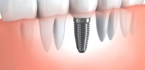 implant dentist near me in nyc